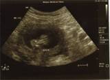 12wk ultrasound