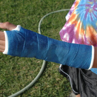 Liams broken arm