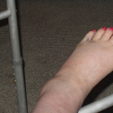 Broken Foot-Toe