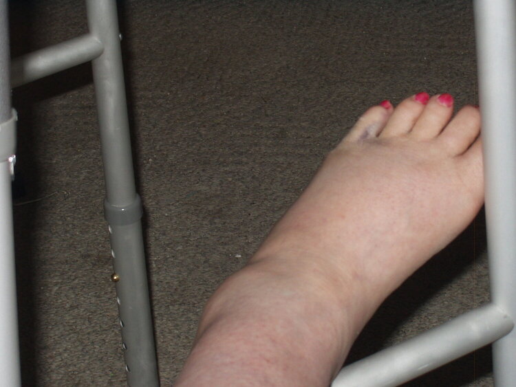 Broken Foot-Toe