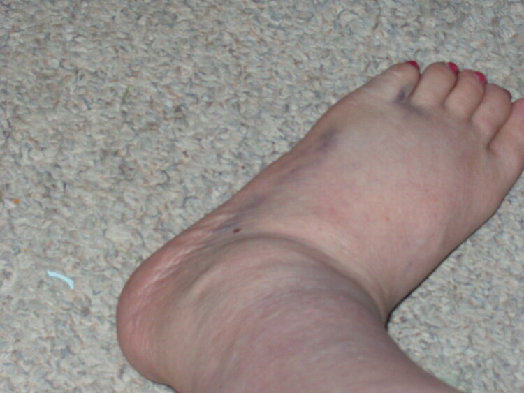 Broken Foot-Side of foot