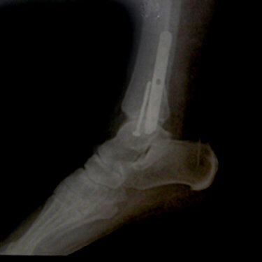 Side View of ankle