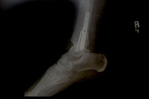 Side View of ankle