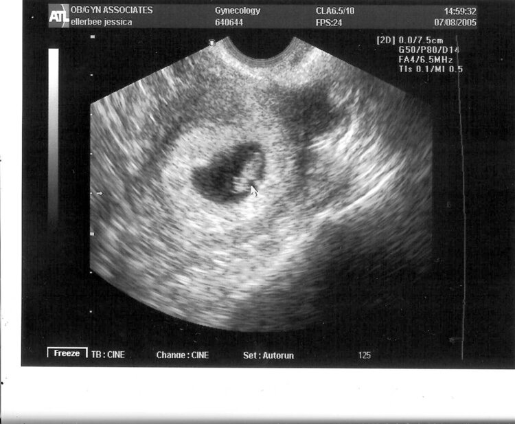 Our Baby&#039;s First Photo!!
