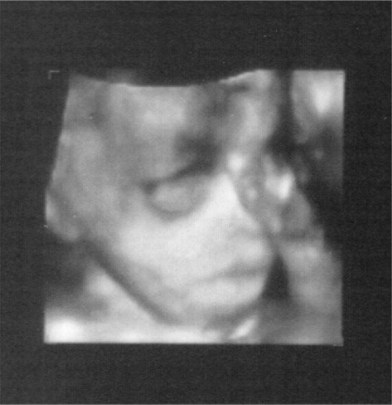 Ultrasound 29 weeks