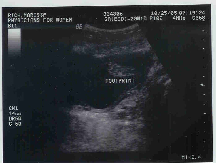 Baby&#039;s Footprint at 20 Weeks