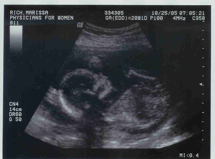 Baby&#039;s Profile at 20 Weeks