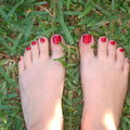 March 7- My pretty polished swollen feet