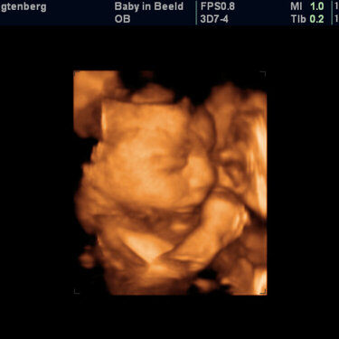 3-d Ultrasound 29 weeks