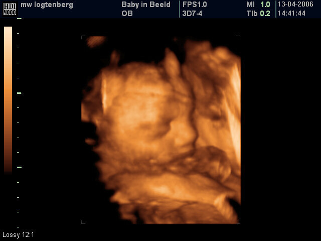 3-d Ultrasound 29 weeks