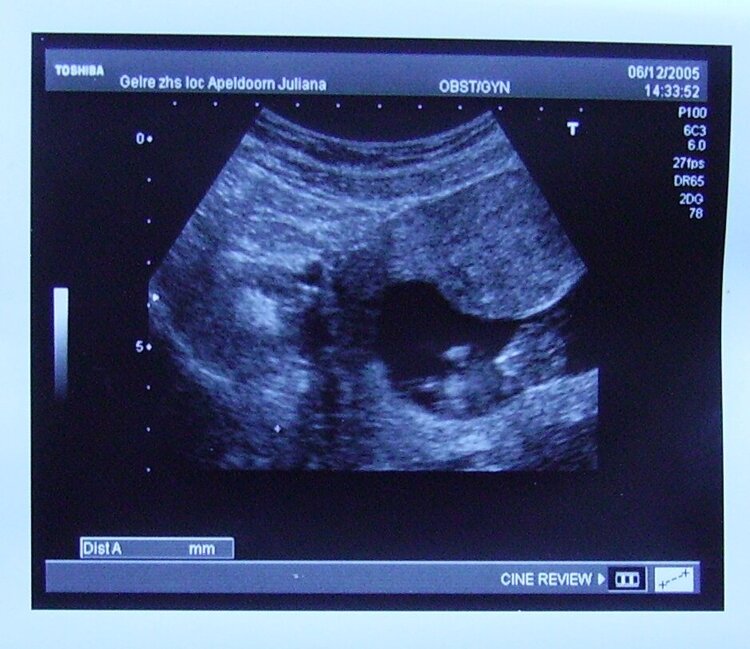 Ultrasound 10 weeks