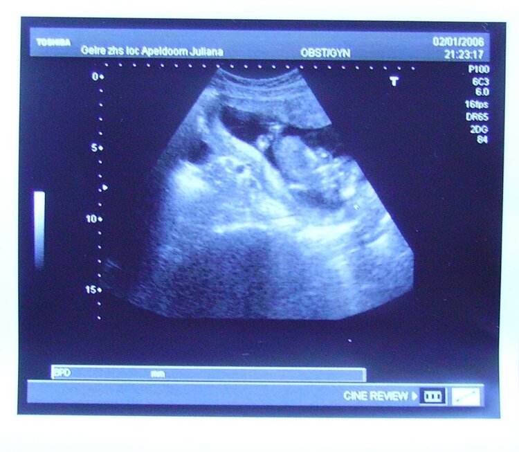 Ultrasound 14 weeks