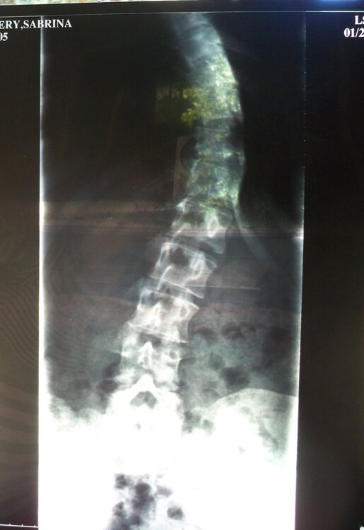 My Spine