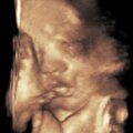 3D Ultrasound Picture