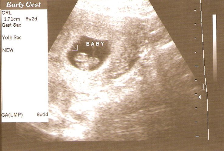Baby # 2 at 8 weeks &amp;amp; 2 days